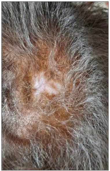 Scalp lesion resolved post-chemotherapy.